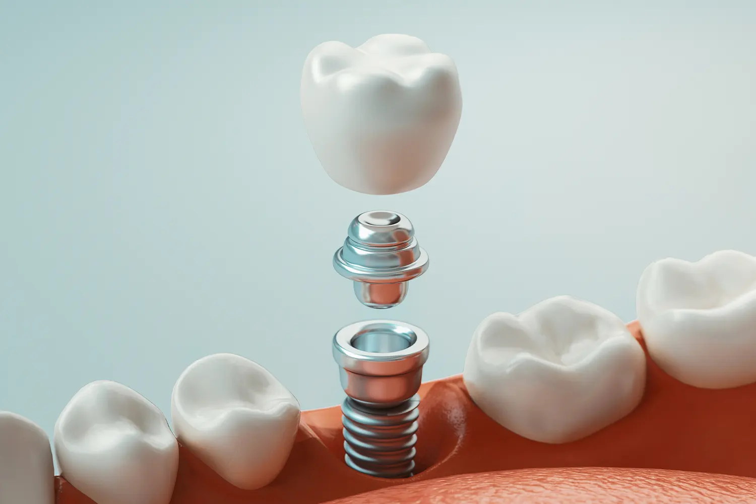 Dental implant procedure illustration.