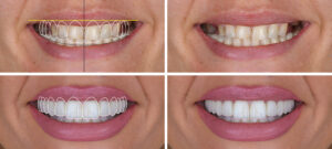 PrintSmile design treatment in dental aesthetic dentistry with laminate veneers and dental crown restorations using computer-aided design. Dental design treatment, before-and-after, and digital design