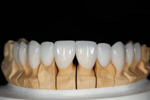 Composite vs. Porcelain Veneers A Newport Beach Cosmetic Dentist's Guide
