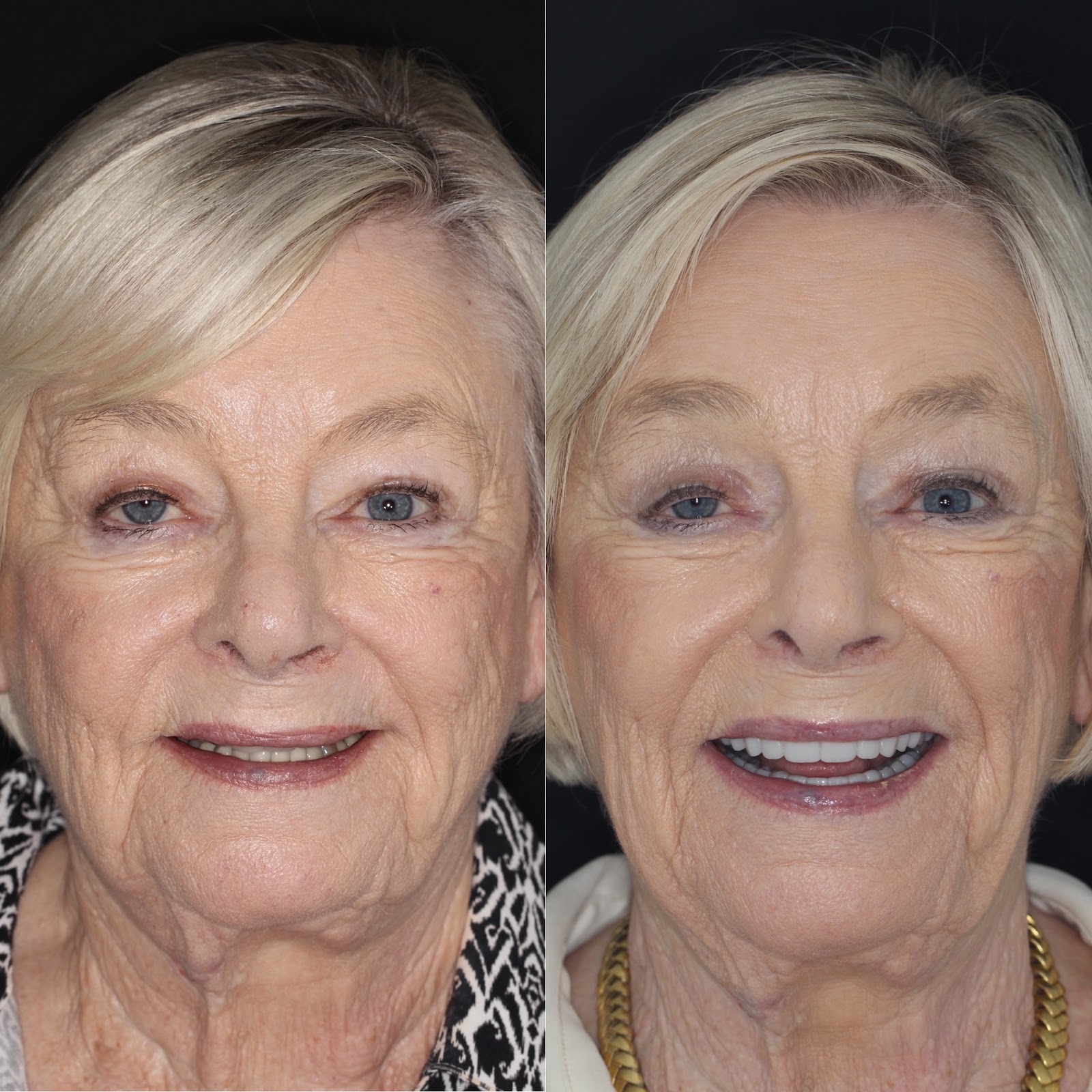 lalume-what-should-i-expect-during-a-full-mouth-rehabilitation