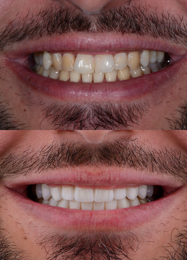 Male smile makeover by dental ceramic veneer, porcelain laminate veneers. Full upper and lower jaw prosthetic with ceramic ultra-thin veneers.