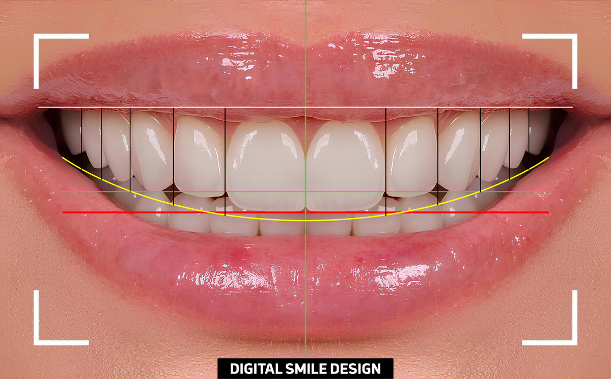 In aesthetic dentistry, smile design treatment involves creating a beautiful smile using computer-aided dental design programs. The design is achieved using E-max and zirconium materials.