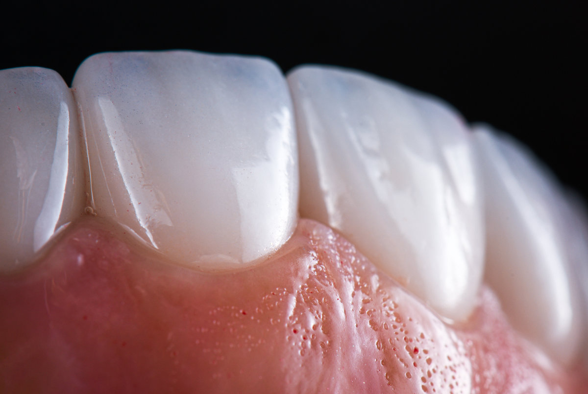 ceramic crowns and veneers