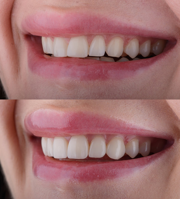 Female smile makeover by dental ceramic veneer, porcelain laminate veneers. Full upper and lower jaw prosthetic with ceramic ultra-thin veneers.