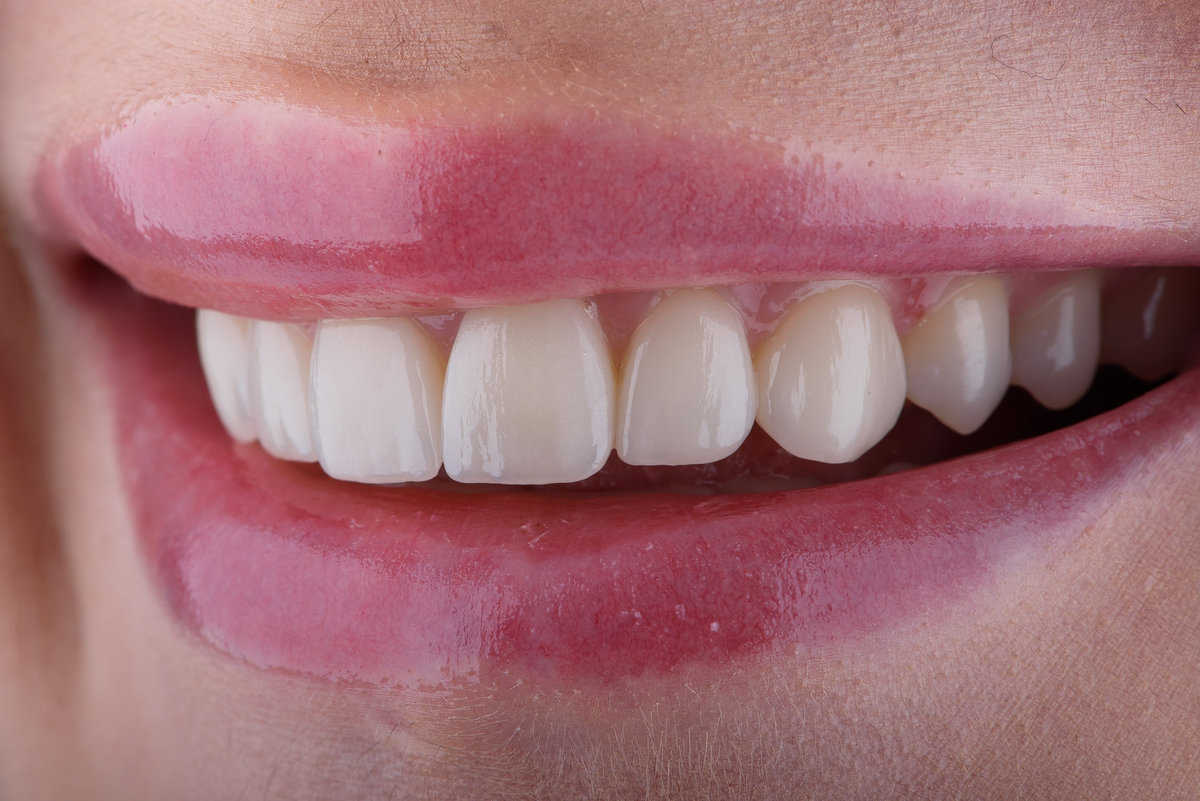 Female smile makeover by dental ceramic veneers, porcelain laminate veneers. Dental ceramic ultrathin veneers on upper jaw.
