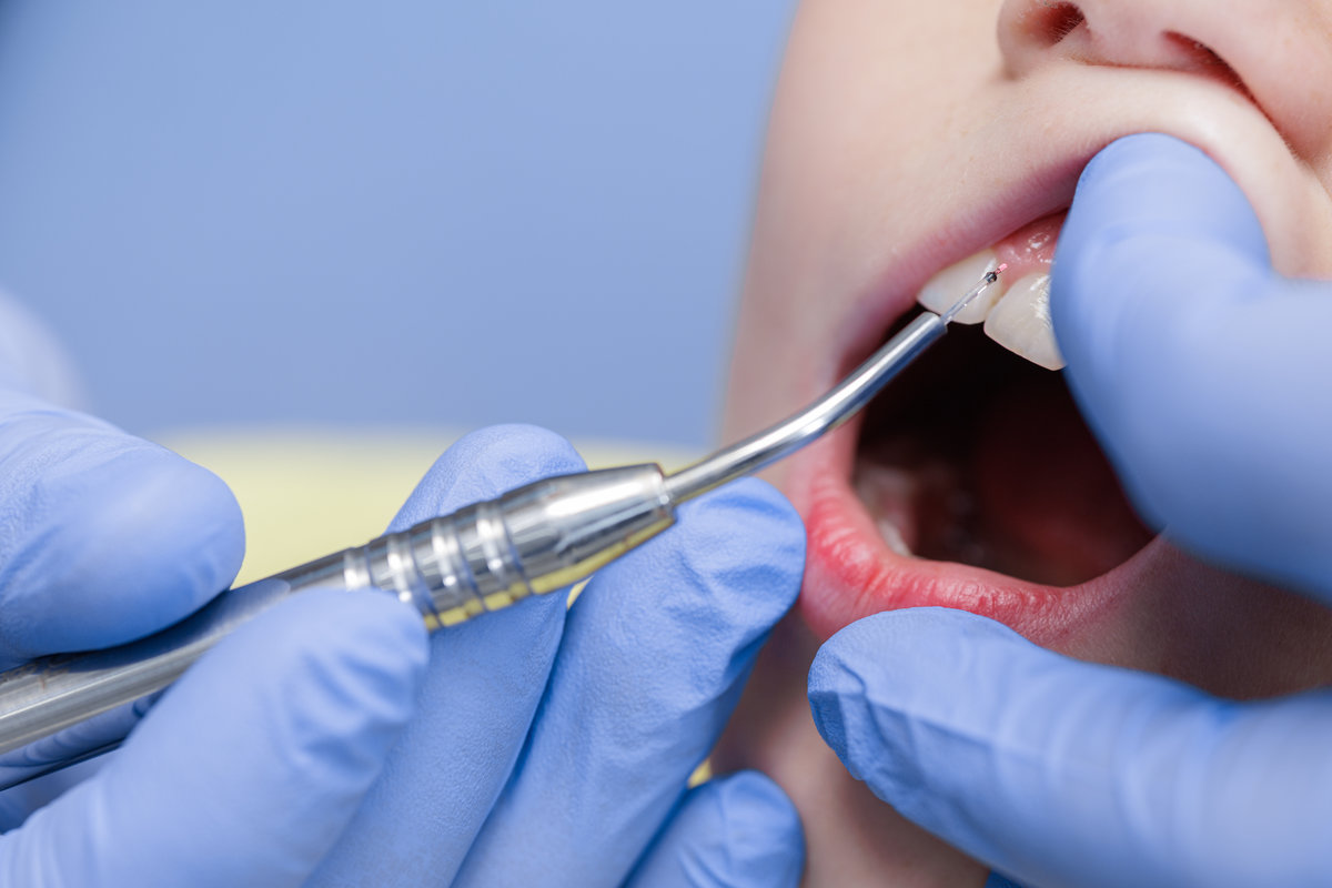 Macro of a diode laser treating gingiva near a child’s incisor during pediatric dental care, highlighting sterile, gentle technique.