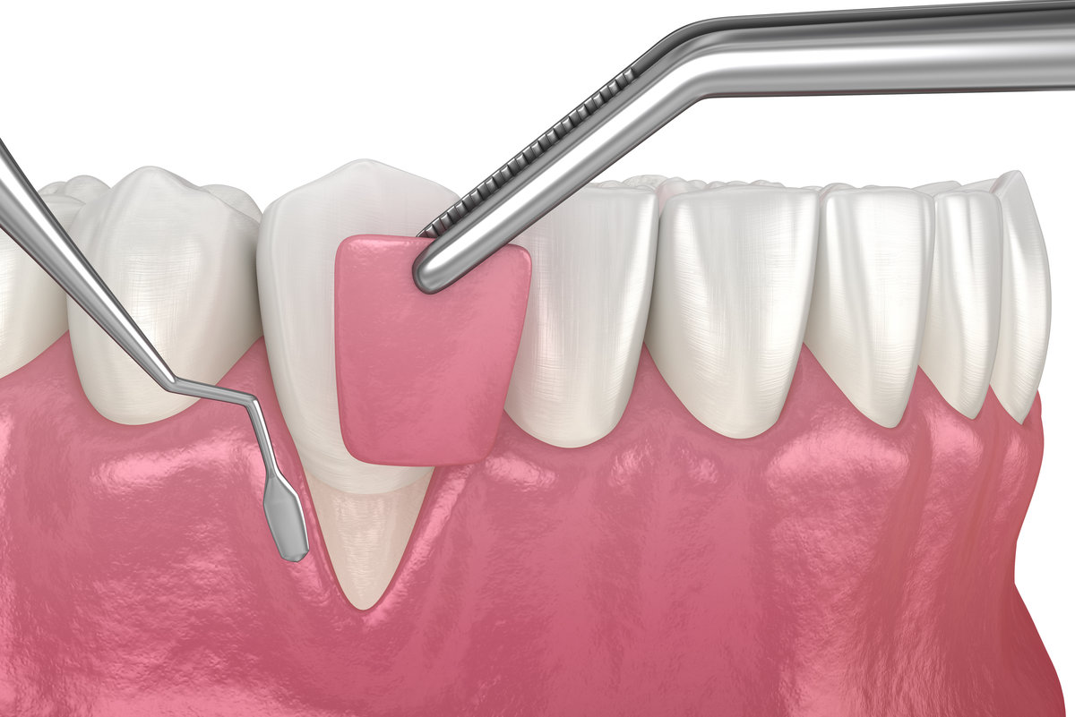 Gum Recession: Soft tissue graft surgery. 3D illustration of Dental treatment