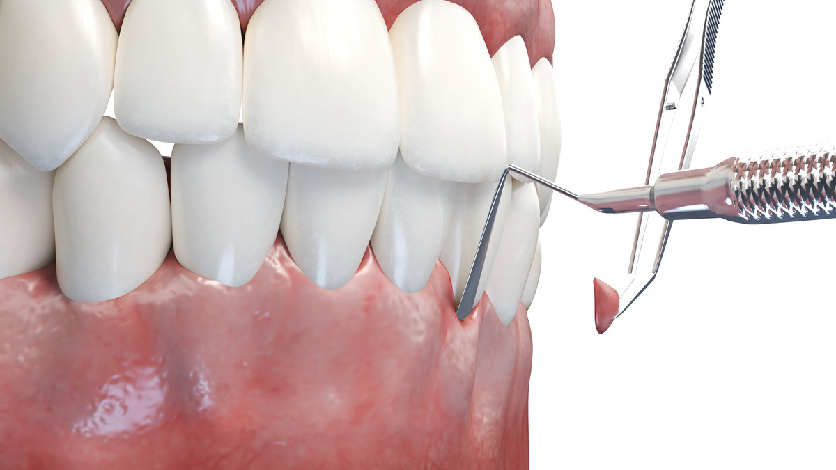 3d rendered illustration of a gum graft surgery
