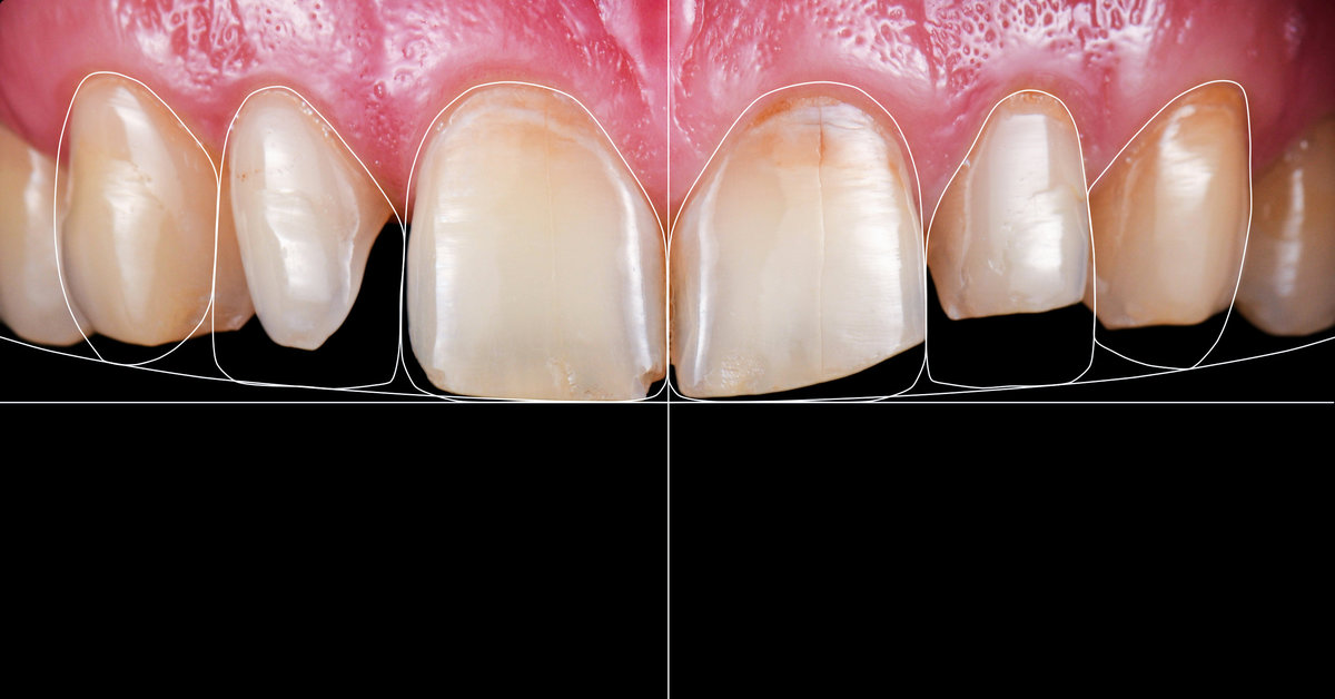 emax ceramic crowns and veneers
