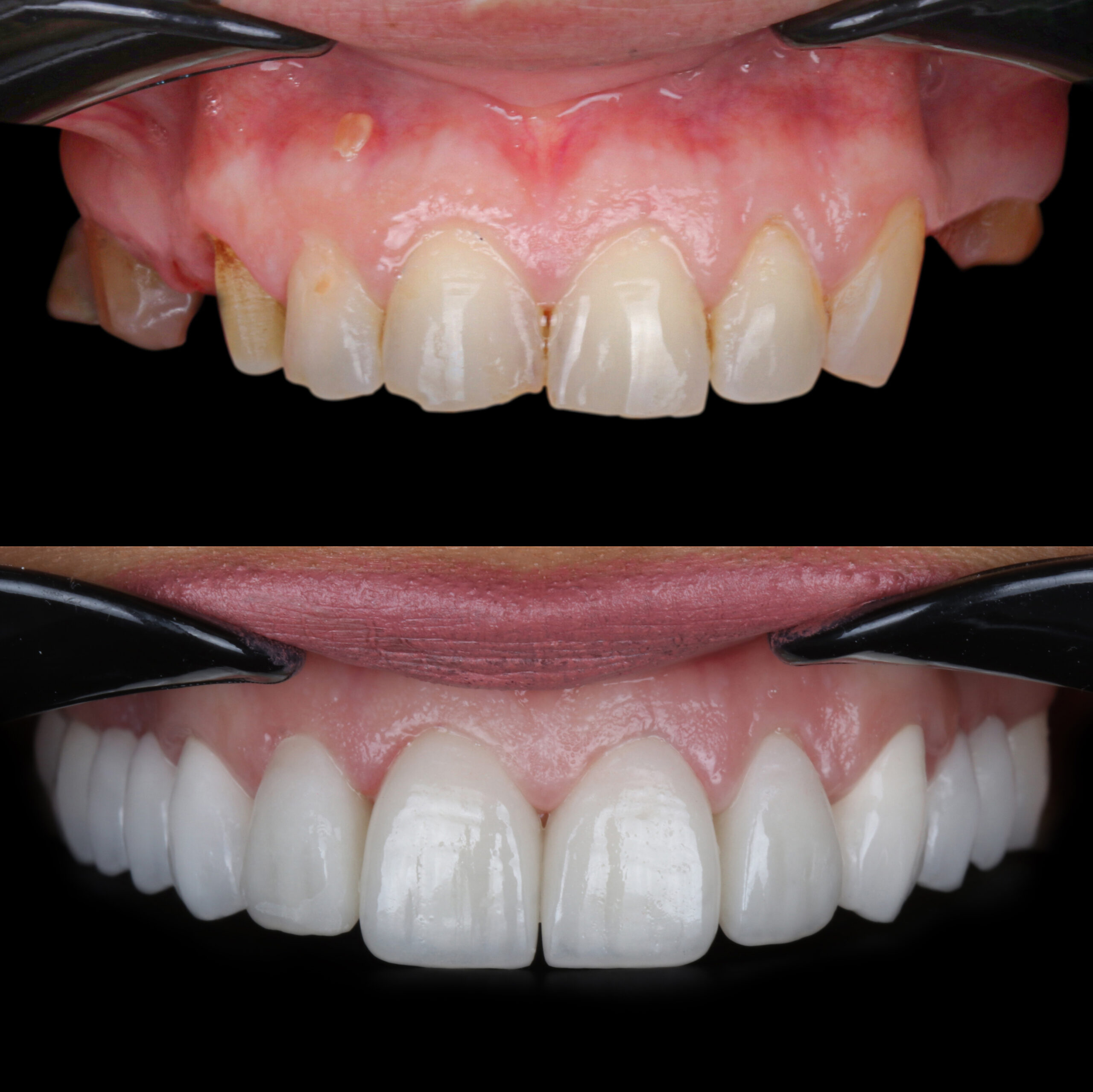 Smile design treatment with cosmetic dentistry. Laminate veneers and zirconia porcelain for a new smile through dental design. Dental before after and smile makeover.