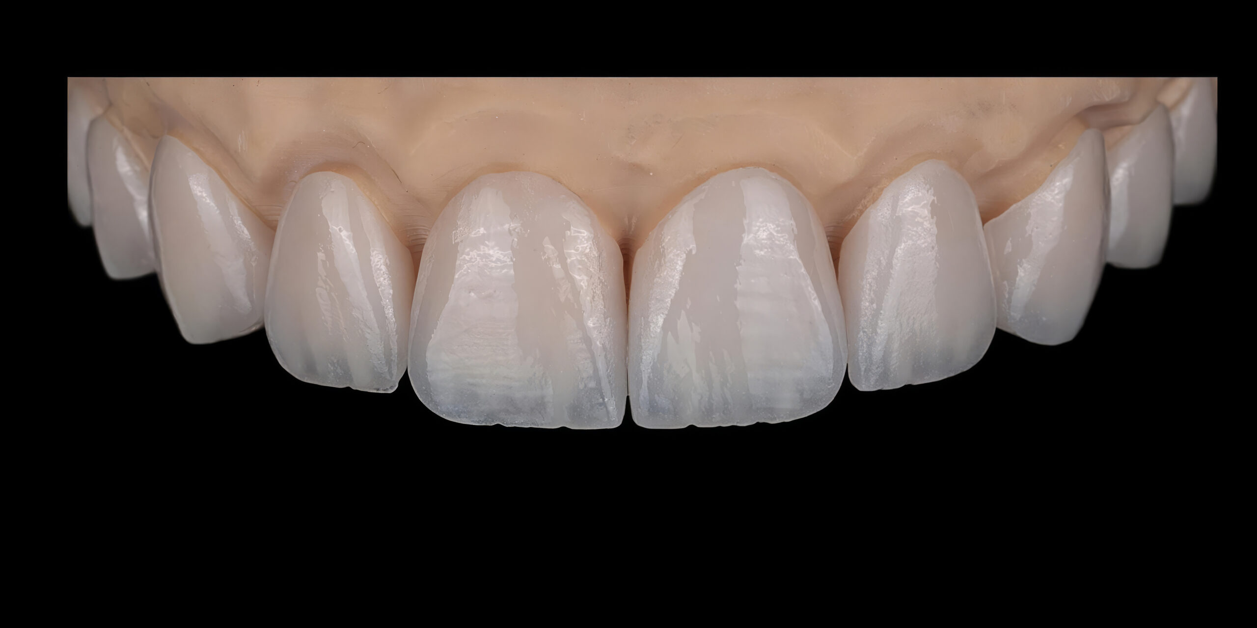 Dental smile design and Hollywood smile. Aesthetic treatment of crooked and deformed teeth using porcelain veneers, aesthetic fillings, and zirconium crowns.